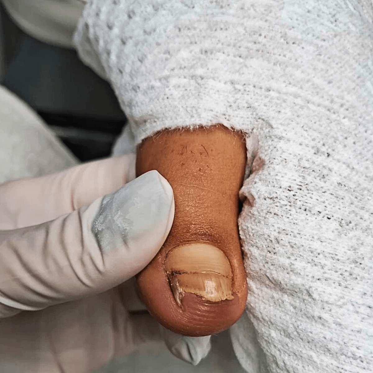 Podóloga realizando limpeza técnica e assepsia no dedo do pé