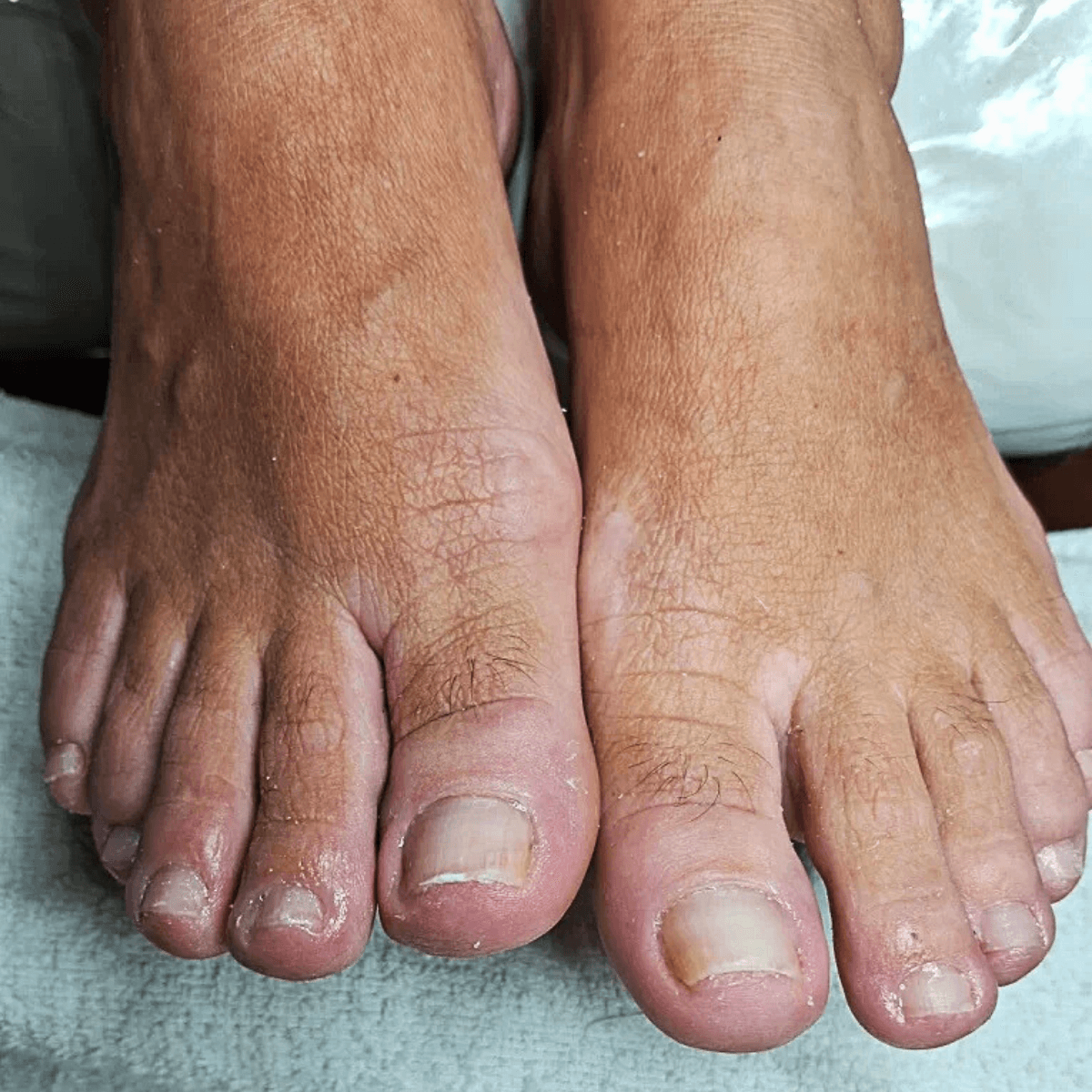 Tratamento para aliviar dor em calos nos dedos dos pés